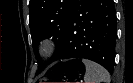 Anomalous left coronary artery from the pulmonary artery (ALCAPA) (Radiopaedia 70148-80181 C 261).jpg