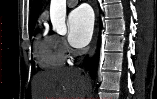 File:Anomalous left coronary artery from the pulmonary artery (ALCAPA) (Radiopaedia 70148-80181 C 94).jpg