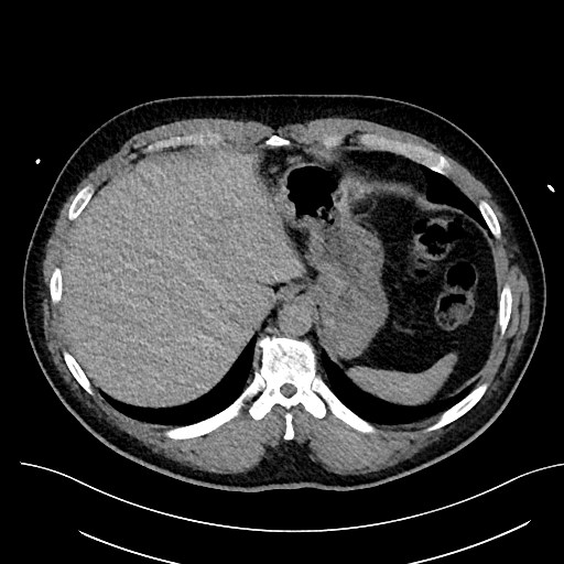 File:Anomalous origin of the left coronary artery with malignant course (Radiopaedia 77842-90126 Axial non-contrast 30).jpeg