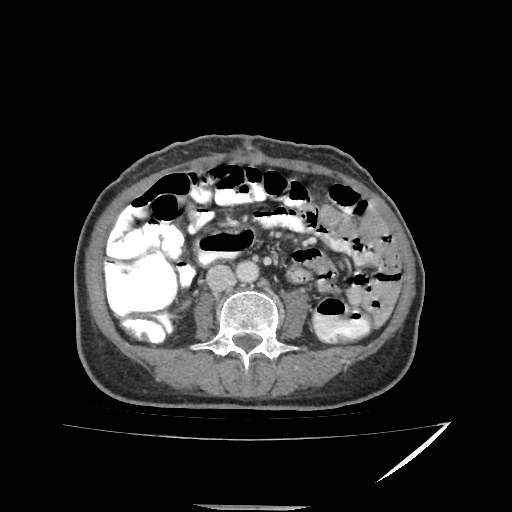 Anorectal carcinoma (Radiopaedia 44413-48064 A 29).jpg