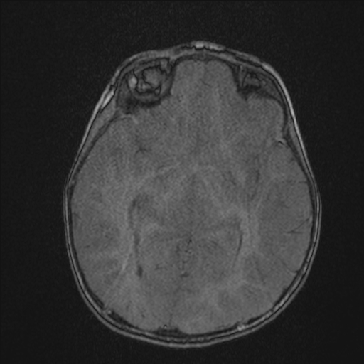 Anoxic brain injury (Radiopaedia 79165-92139 Axial MRA 112).jpg