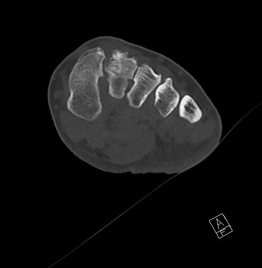 Anterior calcaneal process fracture (Radiopaedia 63353-71943 Axial bone window 73).jpg