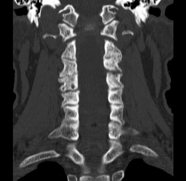 Anterior cervical postdiscectomy arthrodesis (Radiopaedia 32678-33646 Coronal bone window 33).jpg