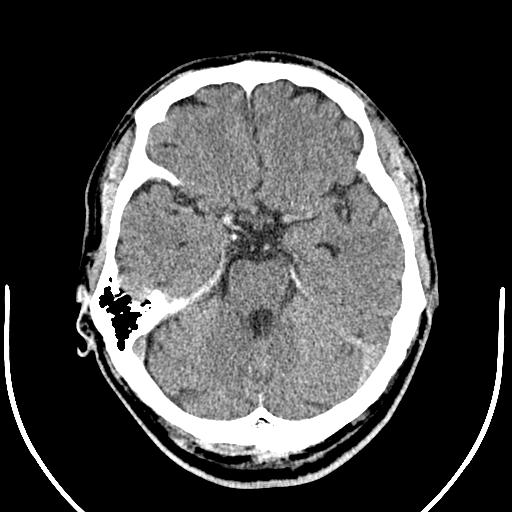 Anterior choroidal artery infarct (Radiopaedia 55106-61480 Axial non-contrast 17).jpg