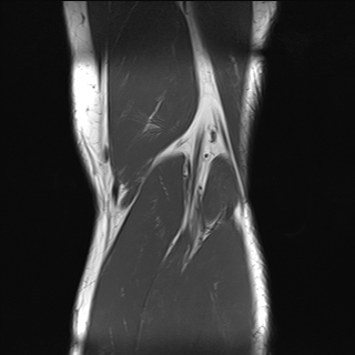 File:Anterior cruciate ligament full thickness tear (Radiopaedia 66268-75467 Coronal T1 20).jpg