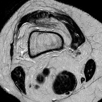 File:Anterior cruciate ligament mucoid degeneration (Radiopaedia 60853-68633 Axial T2 27).jpg