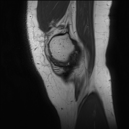 Anterior cruciate ligament rupture and posteromedial corner injury (Radiopaedia 67338-76723 Sagittal PD 29).jpg