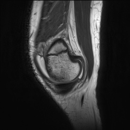 Anterior cruciate ligament tear - pediatric (Radiopaedia 62152-70260 Sagittal PD 30).jpg