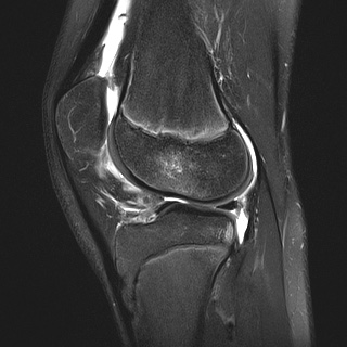 File:Anterior cruciate ligament tear - pediatric (Radiopaedia 62152-70260 Sagittal PD fat sat 24).jpg