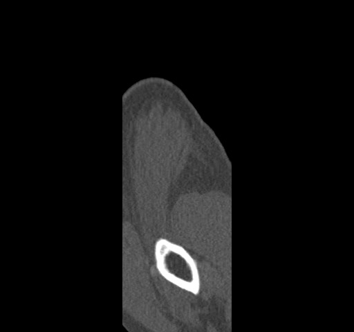 Anterior glenohumeral dislocation with Hill-Sachs lesion (Radiopaedia 62877-71249 Sagittal bone window 3).jpg