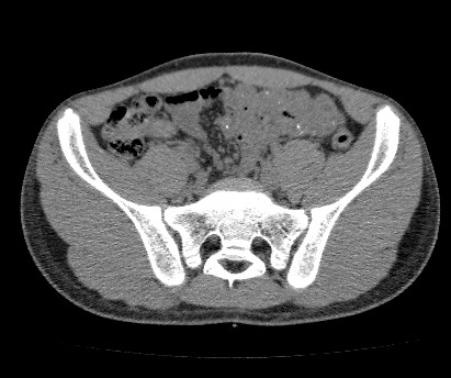 Anterior inferior iliac spine avulsion fracture (Radiopaedia 81312-94999 Axial non-contrast 28).jpg