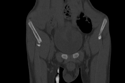 Anterior inferior iliac spine avulsion injury (Radiopaedia 88666-105376 Coronal bone window 16).jpg