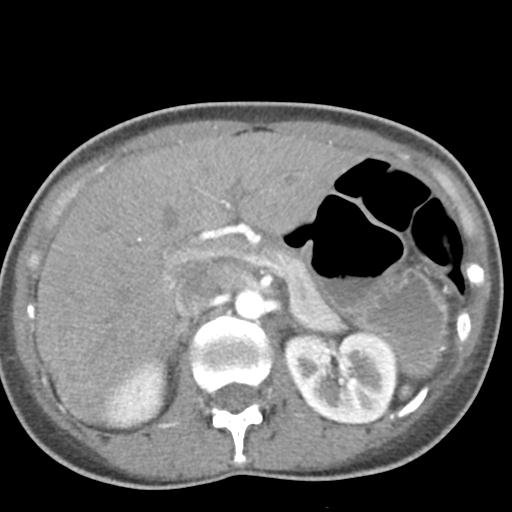 File:Anterior mediastinal lymphoma (Radiopaedia 29556-30061 C 60).jpg