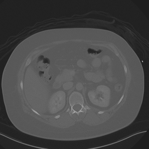 Anterior superior iliac spine avulsion fracture (Radiopaedia 44541-48244 Axial bone window 34).png