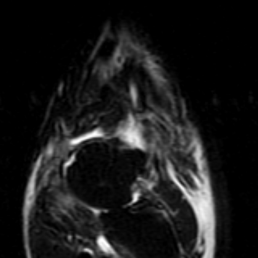File:Anterior talofibular ligament rupture (Radiopaedia 15831-15484 Coronal STIR 4).jpg