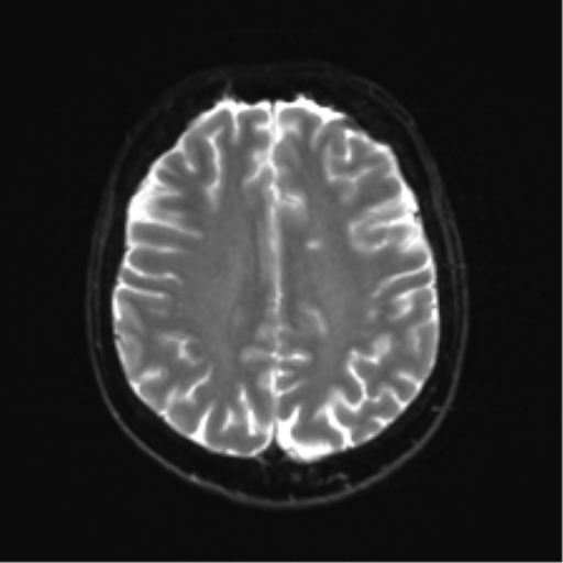 Anterior temporal lobe perivascular space (Radiopaedia 40946-43650 Axial DWI 19).png