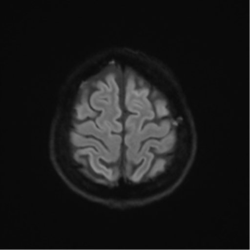 Anterior temporal lobe perivascular space (Radiopaedia 40946-43650 Axial DWI 51).png