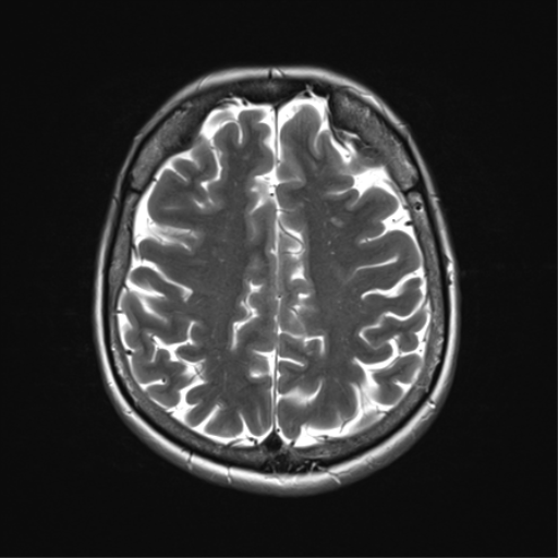 File:Anterior temporal lobe perivascular space (Radiopaedia 40946-43650 Axial T2 28).png