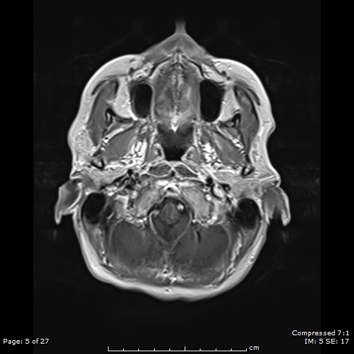 File:Anterior temporal lobe perivascular space (Radiopaedia 88283-104914 Axial T1 C+ 5).jpg