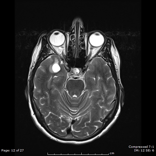 File:Anterior temporal lobe perivascular space (Radiopaedia 88283-104914 Axial T2 12).jpg