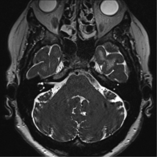 Anterior temporal pole cysts (Radiopaedia 46629-51102 Axial 6).png