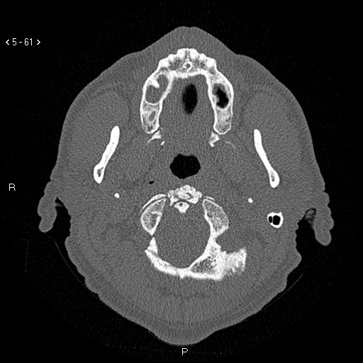 Antrochoanal Polyp (Radiopaedia 70510-80631 Axial bone window 9).jpg