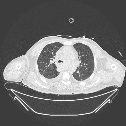Aortic arch aneurysm (Radiopaedia 84109-99365 Axial lung window 114).jpg
