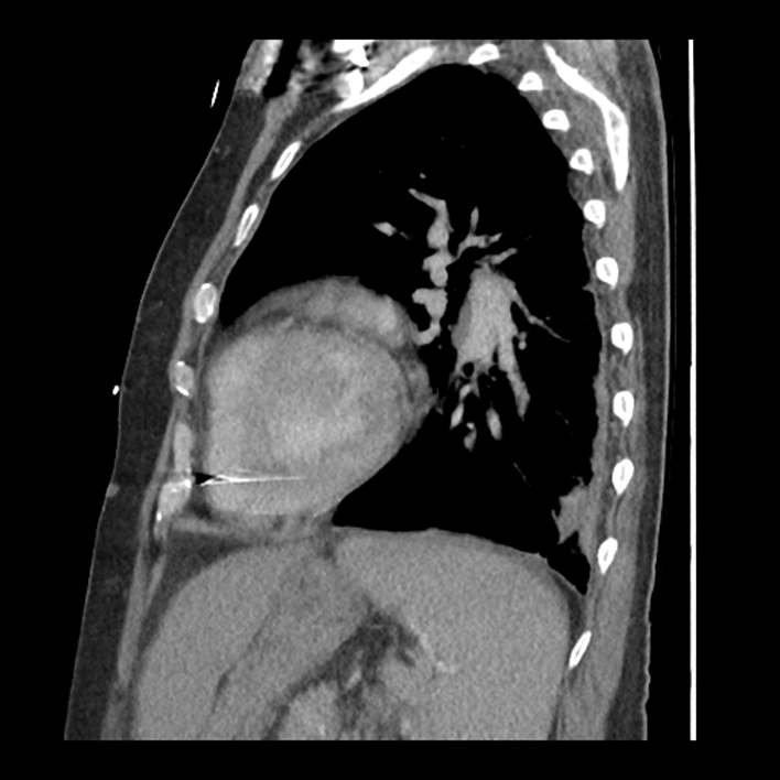 Aortic arch graft infection (FDG PET-CT) (Radiopaedia 71975-82437 C 49).jpg