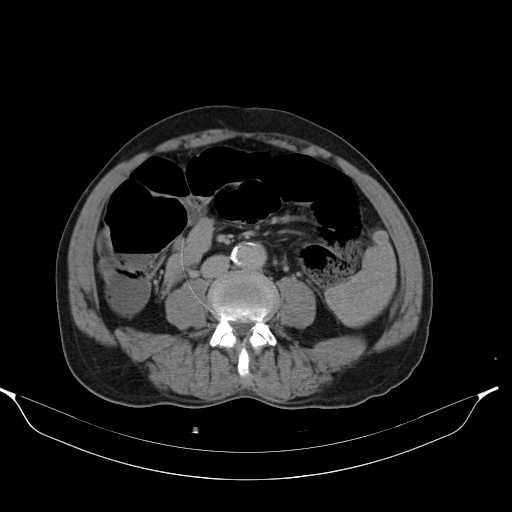 File:Aortic dissection- Stanford type A (Radiopaedia 22085-22085 Axial C+ delayed 31).jpg
