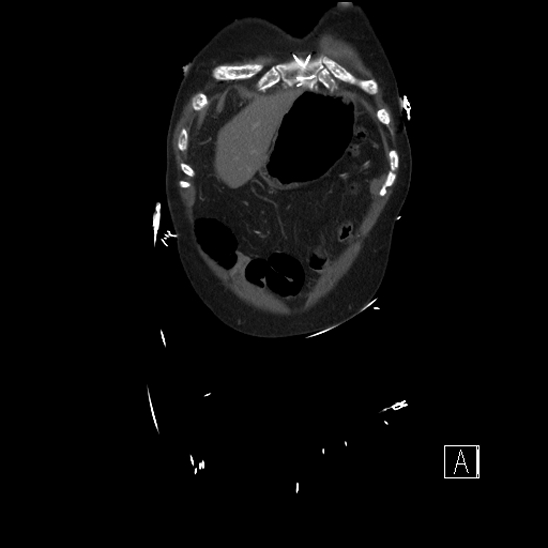 Aortic dissection (CTPA) (Radiopaedia 75506-86750 F 2).jpg