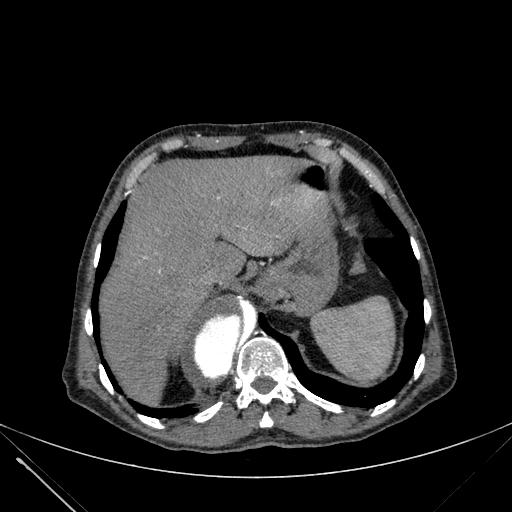 Aortic dissection (Radiopaedia 27466-27665 C+ arterial phase 257).jpg