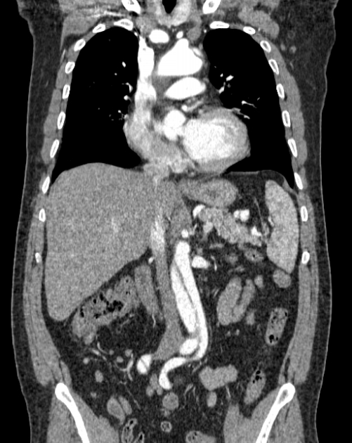 Aortic dissection (Radiopaedia 44411-48061 A 20).jpg