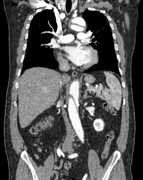 Aortic dissection (Radiopaedia 44411-48061 A 25).jpg