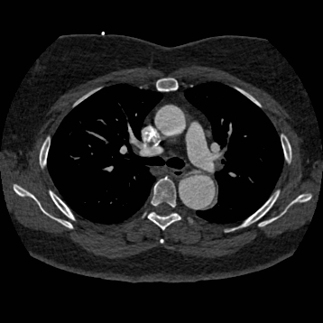 Aortic dissection (Radiopaedia 57969-64959 A 126).jpg