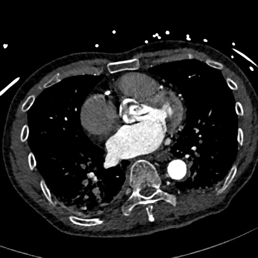 File:Aortic dissection - DeBakey type II (Radiopaedia 64302-73082 A 57).png