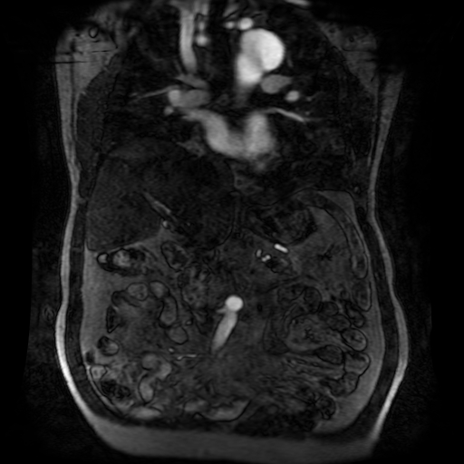 File:Aortic dissection - Stanford A - DeBakey I (Radiopaedia 23469-23551 D 109).jpg