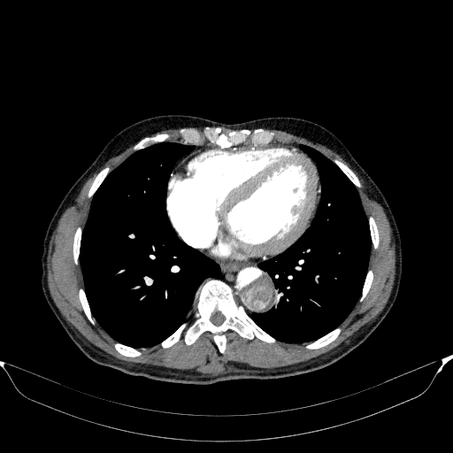File:Aortic dissection - Stanford type A (Radiopaedia 83418-98500 A 44).jpg