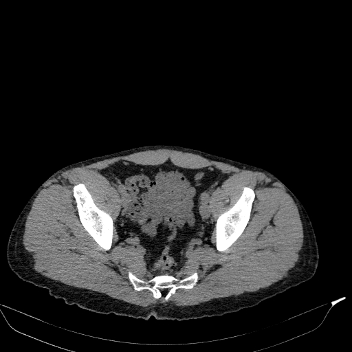 Aortic dissection - Stanford type A (Radiopaedia 83418-98500 Axial non-contrast 83).jpg
