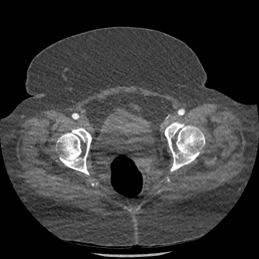File:Aortic dissection - Stanford type B (Radiopaedia 88281-104910 A 156).jpg
