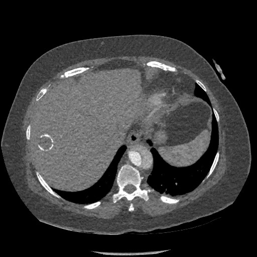 File:Aortic dissection - Stanford type B (Radiopaedia 88281-104910 A 79).jpg
