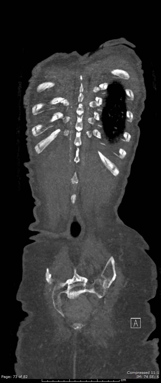 Aortic dissection with extension into aortic arch branches (Radiopaedia 64402-73204 A 73).jpg