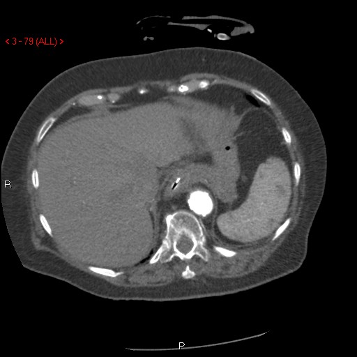 Aortic intramural hematoma (Radiopaedia 27746-28001 A 79).jpg