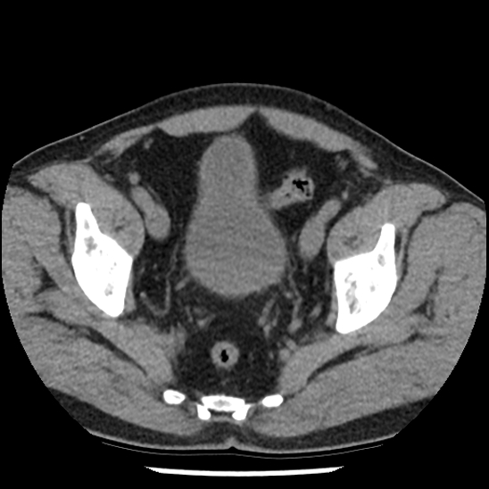 Aortic intramural hematoma (type B) (Radiopaedia 79323-92387 Axial non-contrast 104).jpg