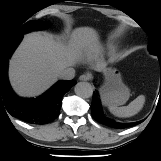 Aortic intramural hematoma (type B) (Radiopaedia 79323-92387 Axial non-contrast 45).jpg