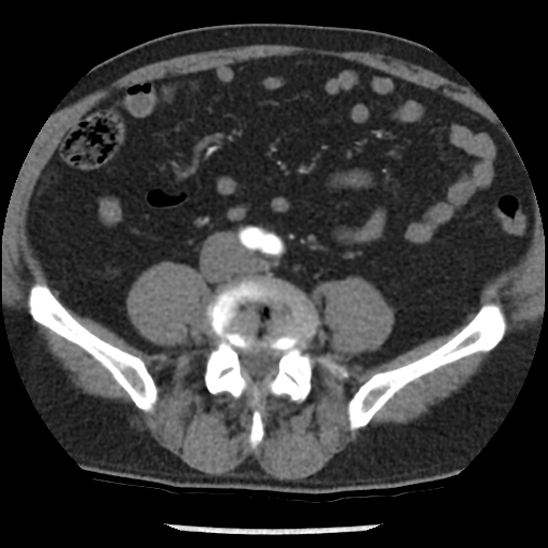 Aortic intramural hematoma (type B) (Radiopaedia 79323-92387 B 85).jpg