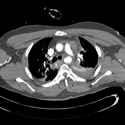 Aortic transection, diaphragmatic rupture and hemoperitoneum in a complex multitrauma patient (Radiopaedia 31701-32622 A 33).jpg