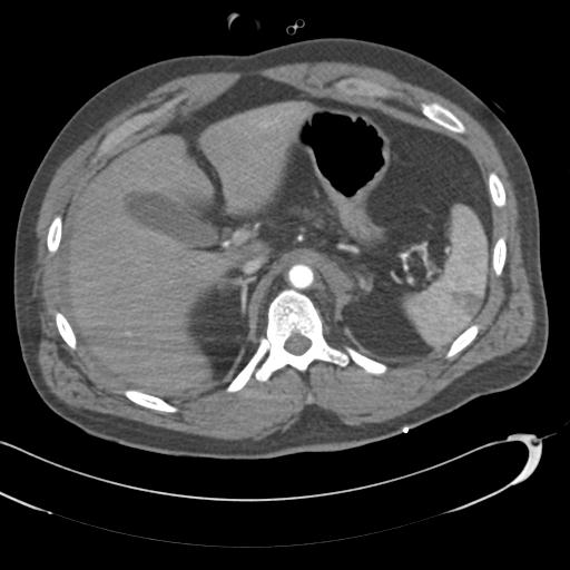 Aortic transection, diaphragmatic rupture and hemoperitoneum in a complex multitrauma patient (Radiopaedia 31701-32622 A 88).jpg