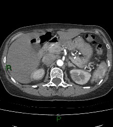 Aortic valve endocarditis (Radiopaedia 87209-103485 C 101).jpg