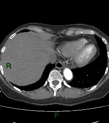 File:Aortic valve endocarditis (Radiopaedia 87209-103485 C 78).jpg