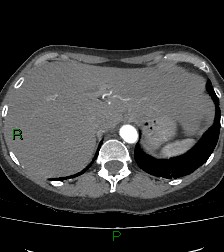 Aortic valve endocarditis (Radiopaedia 87209-103485 C 87).jpg